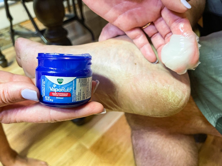 hand putting on vicks vaporub on cracked heels of feet
