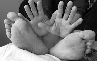 Itchy-fungal-feet-hands