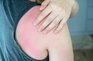 20181212 kcl witch hazel hacks treat sunburns 02 1544826460