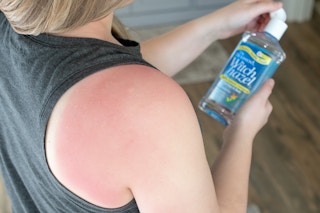 20181212 kcl witch hazel hacks treat sunburns 03 1544826464