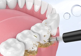 amazon plaque removal kit 2023 2 1677086354 1677086354