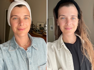 A before and after shot of a person who started using Glycolic acid pads